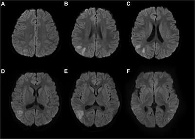 Two pediatric patients with hemiplegic migraine presenting as acute encephalopathy: case reports and a literature review